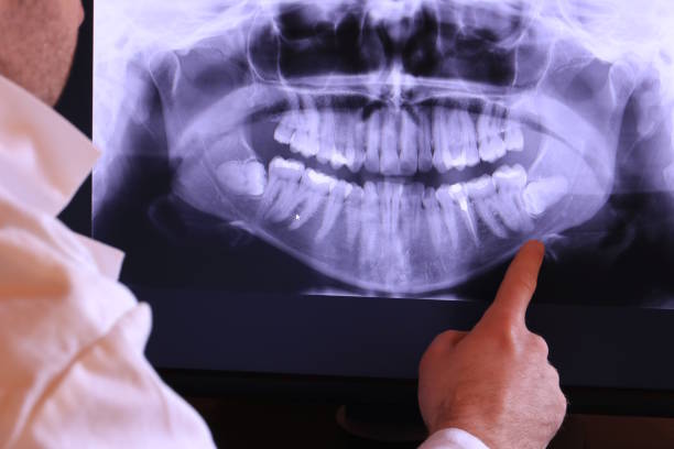 Best Emergency Wisdom Teeth Removal in Lockport Heights, LA